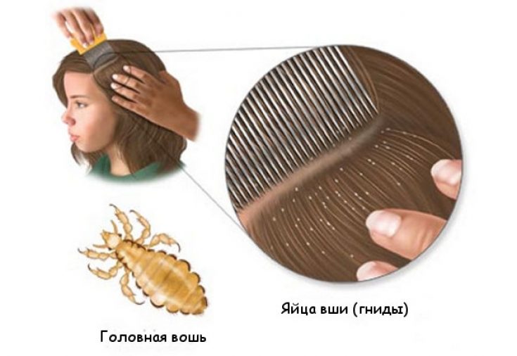 Как избавится от насекомых из волосы