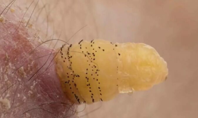 Личинки мух у человека