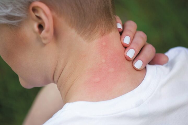 Признаки укусов комаров на теле