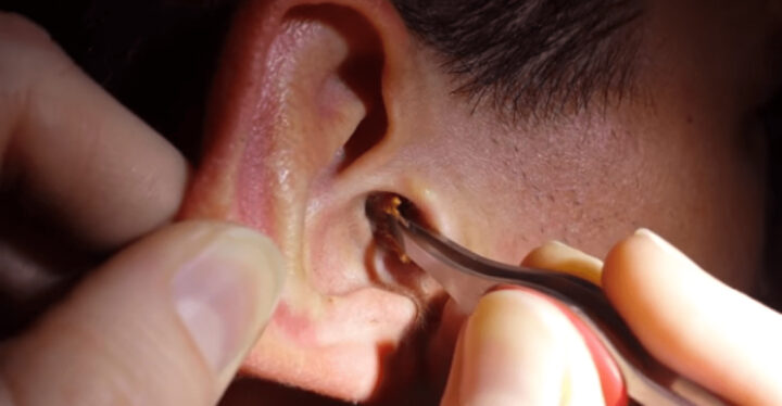 Таракан в ухе: симптомы и удаление
